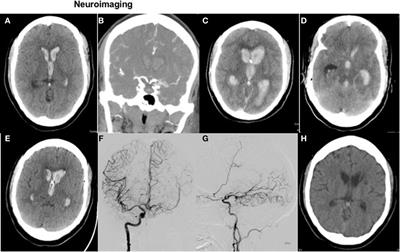 Intracerebral Hemorrhage with Intraventricular Extension—Getting the Prognosis Right Early